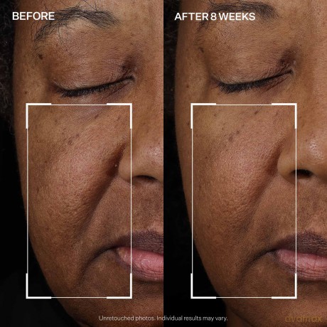 StriVectin Tighten & Lift Peptight? (Face Lift Serum) 30 ml