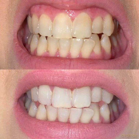 Cmiile - Teeth Whitening Strips