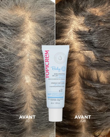 Baby Anti-Dandruff Hair Gel (Flash Cradle Cap) 40 ml