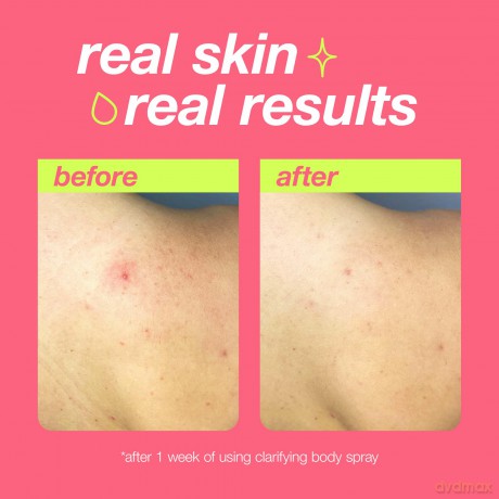 Clear Start Clarifying Body Spray 177 ml