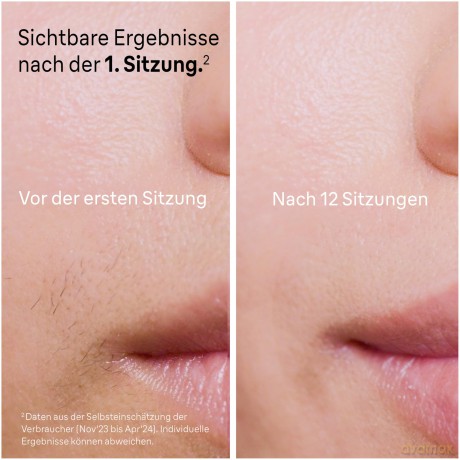 Braun - Smart IPL Skin I-Expert PL7147