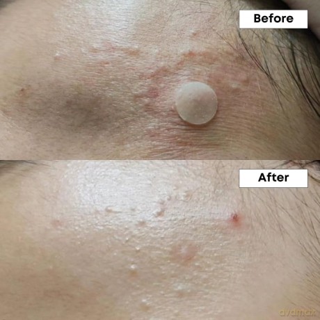 Nineless - A-Control 10% Azelaic Acid Serum - 30 ml [KOMSETYKI]