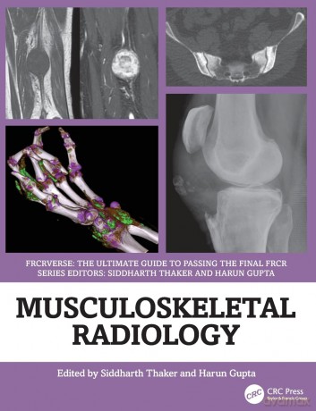 Musculoskeletal Radiology: An Ultimate Guide to Passing the Final FRCR (FRCRverse) - Siddharth Thaker [KSIĄŻKA]