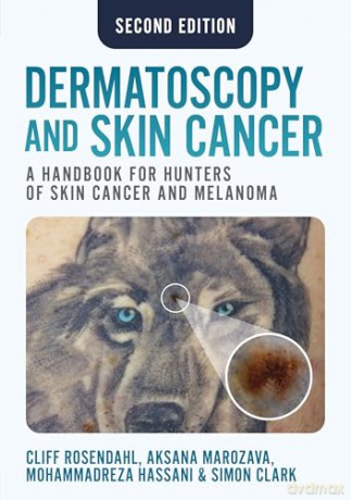 Dermatoscopy and Skin Cancer, second edition: A Handbook for Hunters of Skin Cancer and Melanoma - Aksana Marozava [KSIĄŻKA]