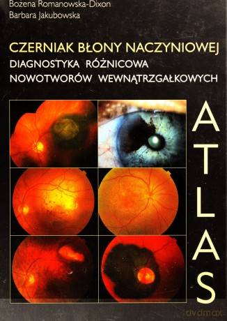 Czerniak błony naczyniowej. Diagnostyka różnicowa [KSIĄŻKA]