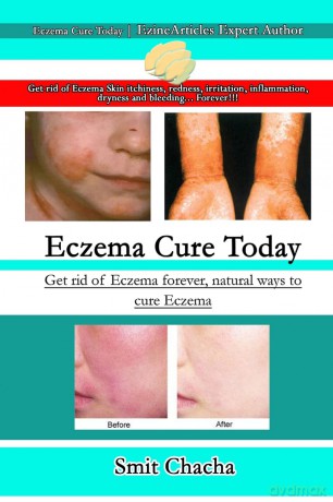 Eczema Cure Today - Get rid of Eczema forever natural ways to cure Eczema - Smit Chacha [KSIĄŻKA]
