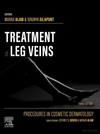 Treatment of Leg Veins - Murad Alam, Sirunya Silapunt [KSIĄŻKA]