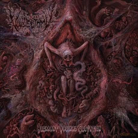 Vulvectomy: Aberrant Vaginal Gestation [CD]