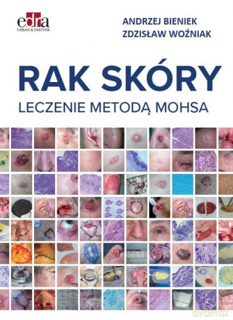 Rak skóry Leczenie metodą Mohsa - Andrzej Bieniek, Zdzisław Woźniak [KSIĄŻKA]
