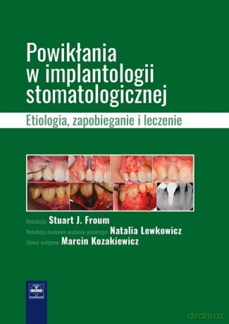 Powikłania w implantologii stomatologicznej. - Stuart J. Froum [KSIĄŻKA]